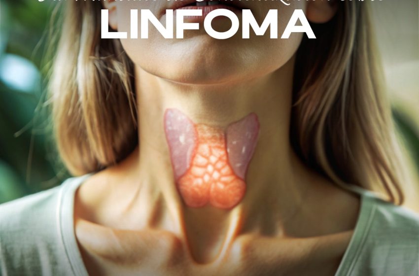  Emite SSM recomendaciones para detectar un linfoma