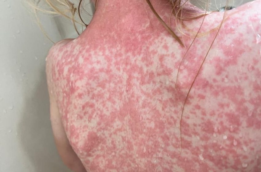  📰 Michoacán registra la primera muerte por sarampión en México durante 2026