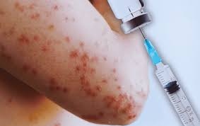  México se asoma al año de transmisión constante de sarampión